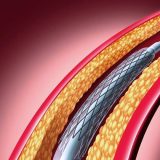 Coronary Stent Market