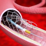 Vascular Stent Market